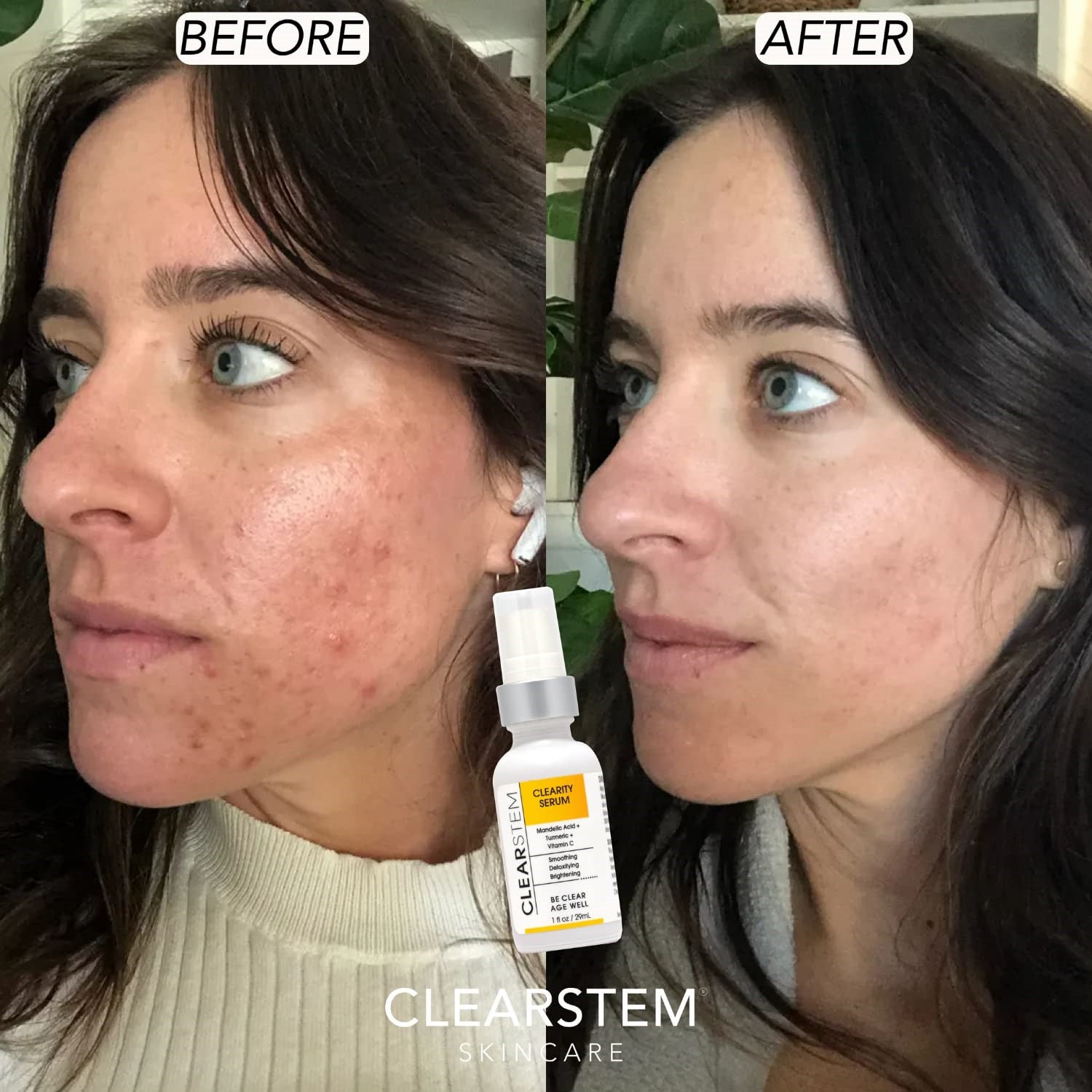 CLEARstem CLEARITY Mandelic Acid Serum - Blackhead, Acne Dissolver 1 oz