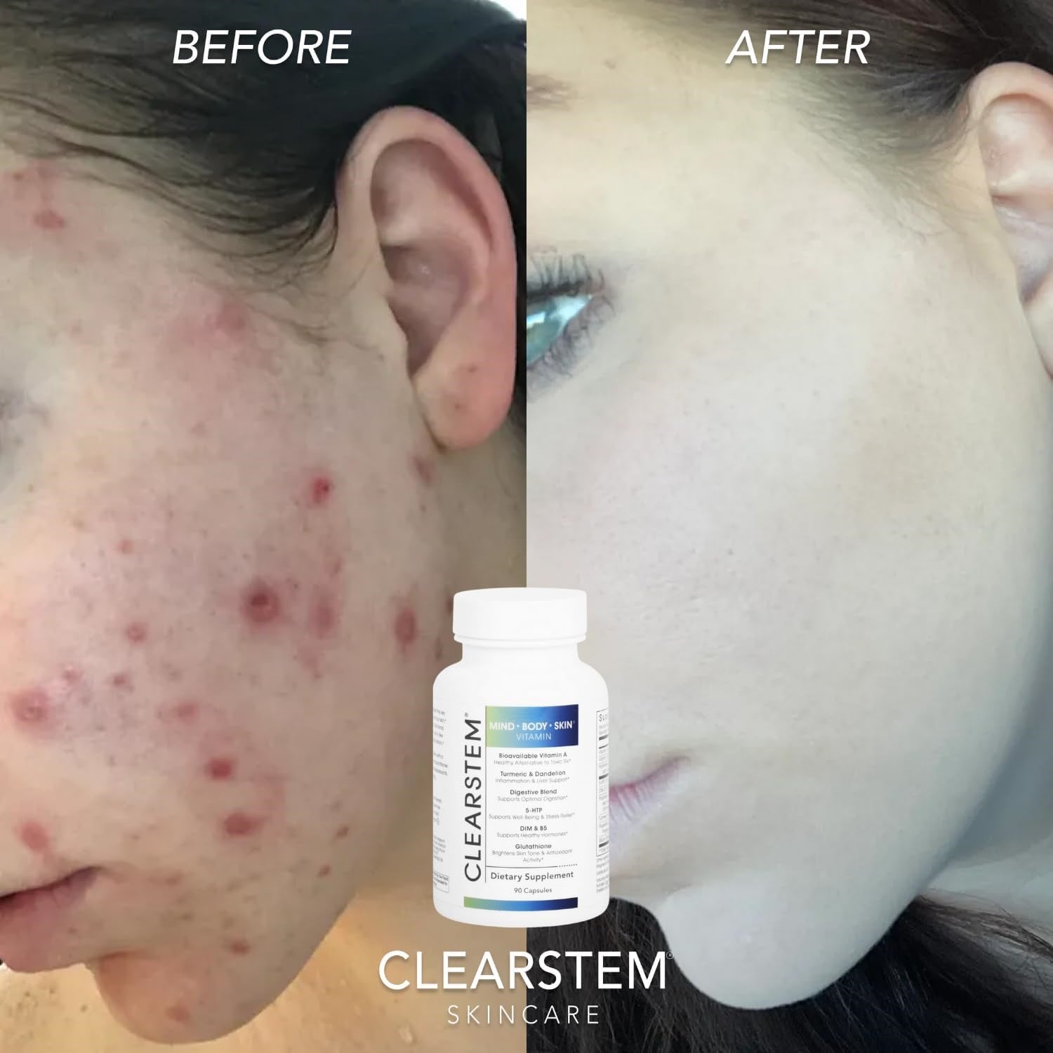 CLEARstem MINDBODYSKIN Hormonal Acne Supplement